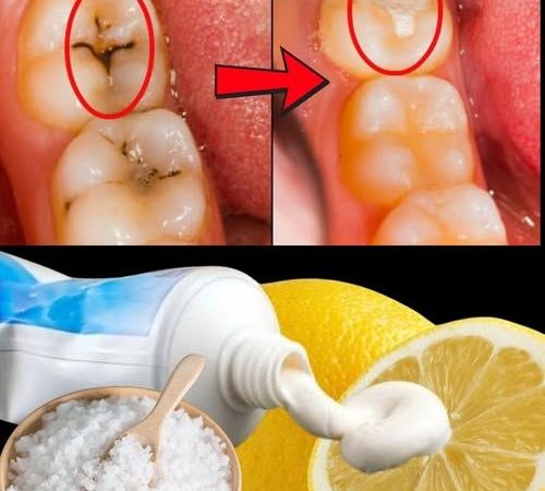 Heal Early Cavities Naturally: 6 Powerful Tips to Protect Your Smile