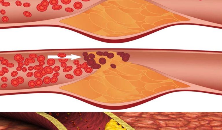 Most people miss this. 10 warning signs saying your arteries are clogged