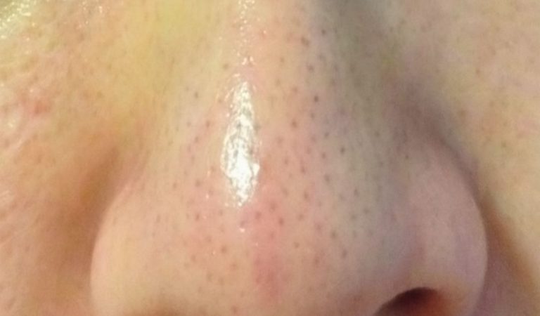 What Are Sebaceous Filaments and Why Are They on Your Face?
