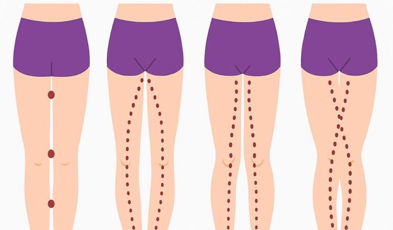 Understanding Different Types of Leg Alignment: What Your Legs Say About Your Posture and Health