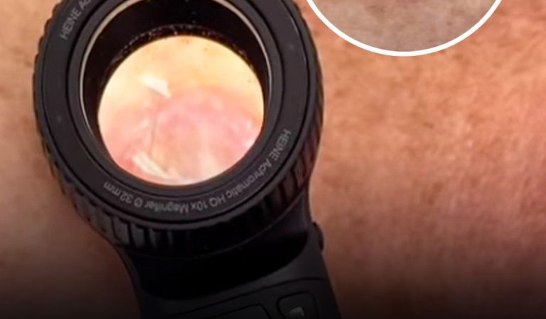Doctor shares sh0cking video of ‘worst’ skin c-ancer he’s ever seen and issues urgent warning