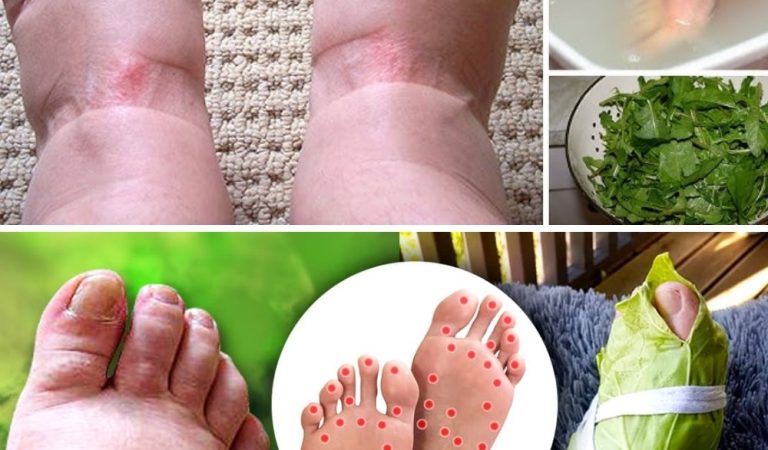 8 Natural Remedies to Soothe Swollen Legs and Joint Inflammation