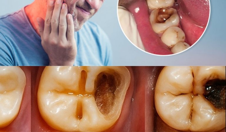 Tired of Cavities? Try These Natural Tips for Stronger, Healthier Teeth