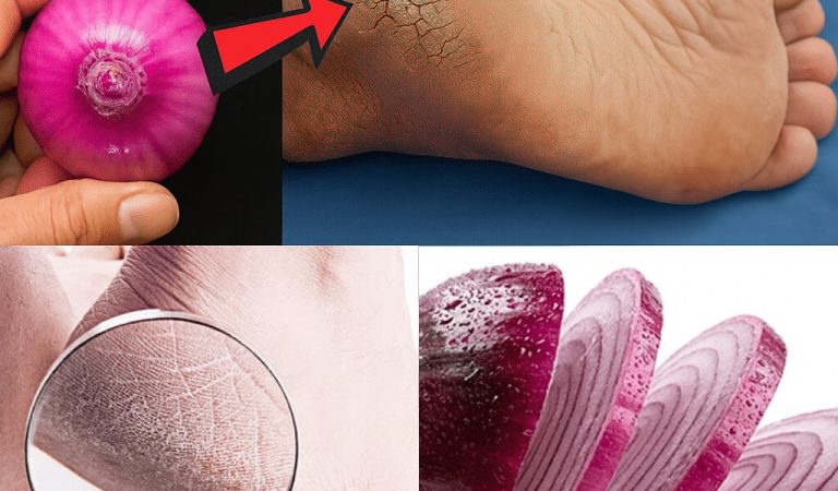 Say Goodbye to Cracked Heels Forever: The Astonishing Red Onion Remedy for Silky, Beautiful Feet Say Goodbye to Cracked Heels Forever: The Astonishing Red Onion Remedy for Silky, Beautiful Feet