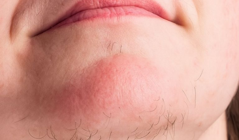 What Chin Whiskers Might Tell You About Your Health